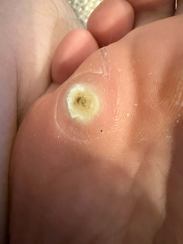 족저사마귀-자가치료-7일차-사진