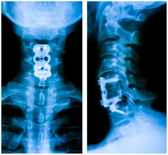 경추 유합술(Cervical Fusion, 척추 고정술): 수술 원리 및 회복 과정