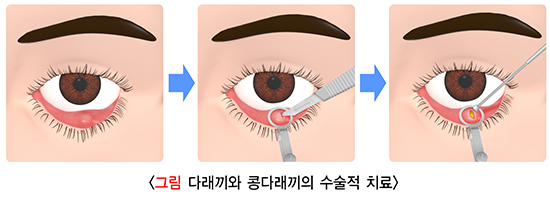 댜래끼치료