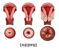 자궁경부암 예방접종
