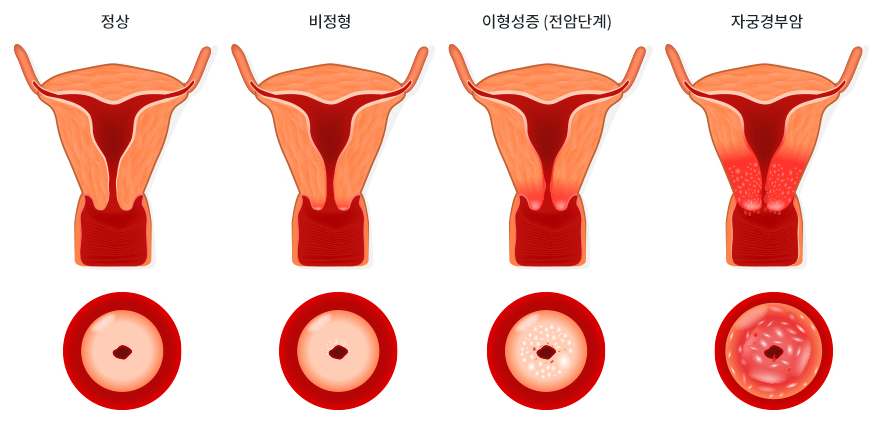 hpv 바이러스와 자궁경부암