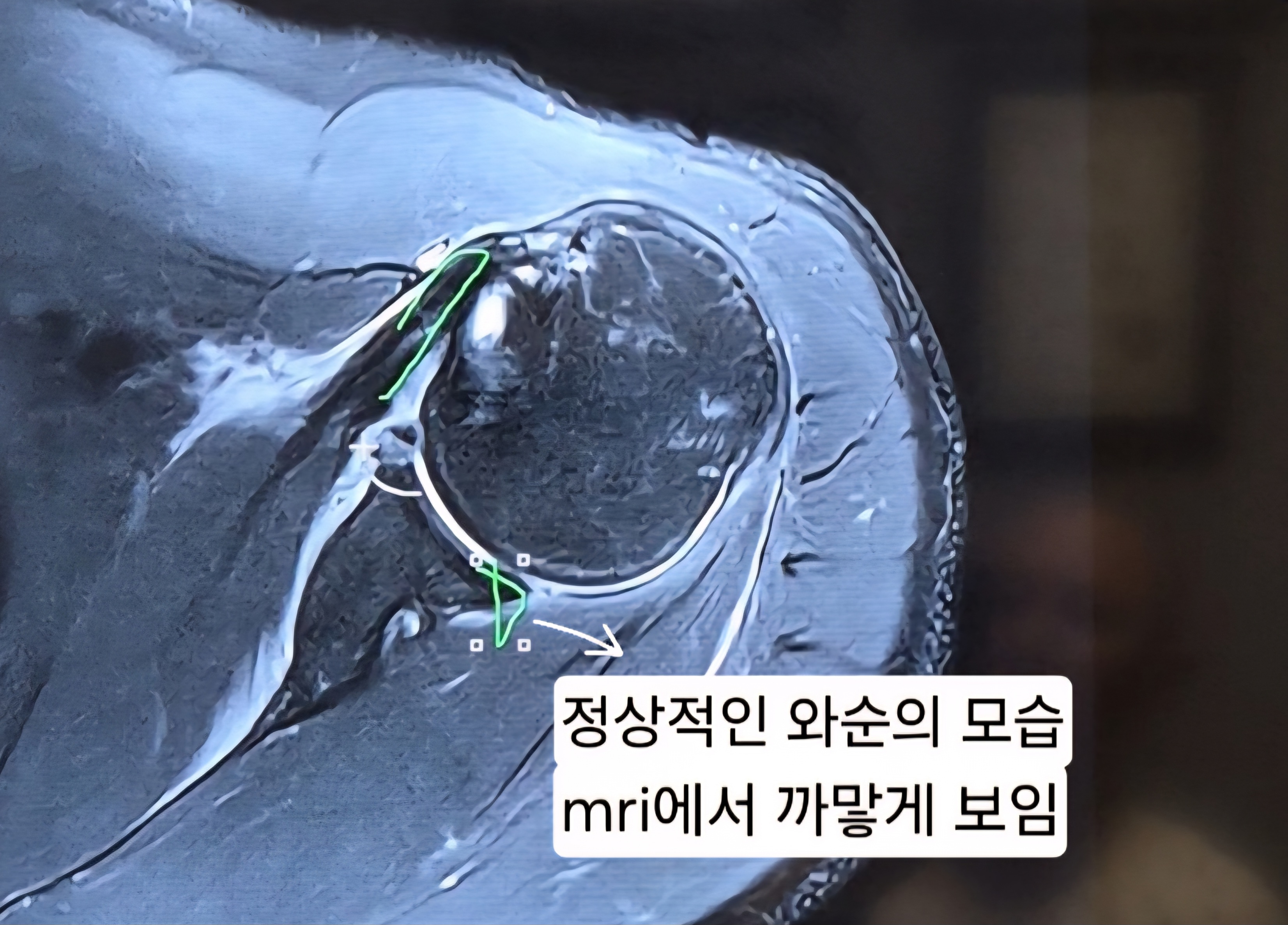 어깨 와순파열 봉합수술 후 mri사진 물리치료 기록
