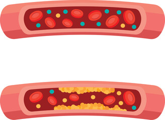 콜레스테롤 질환 원인 음식