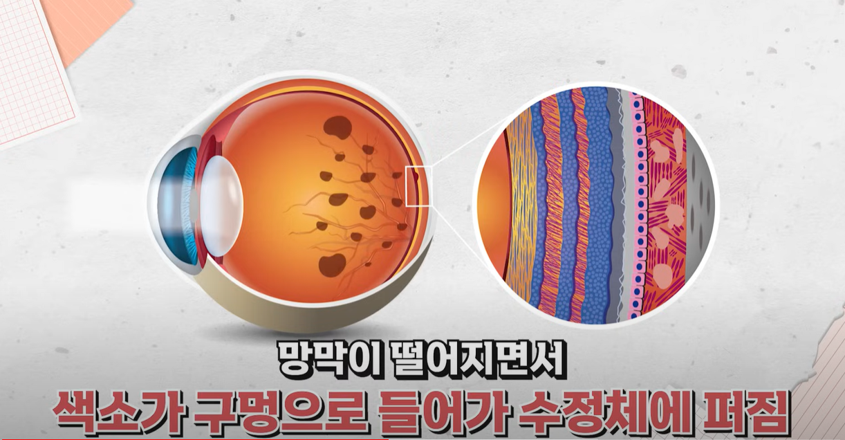 색소가 수청체에 퍼지는 현상입니다.