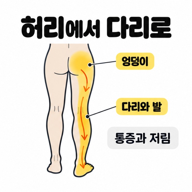 엉덩이에서 한쪽 다리와 발까지 노란색과 아래쪽 화살표로 연결하고 통증과 저림을 설명한 그림