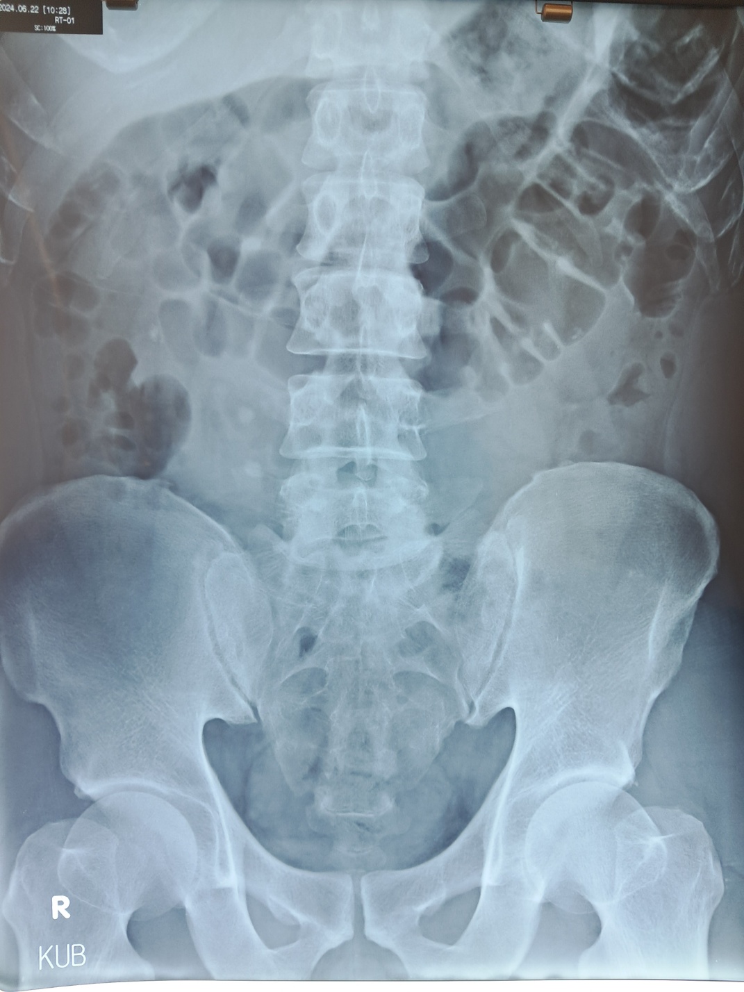 요로결석 엑스레이