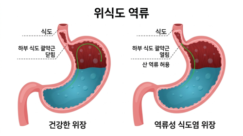건강과 위장과 역류성 식도염 위장