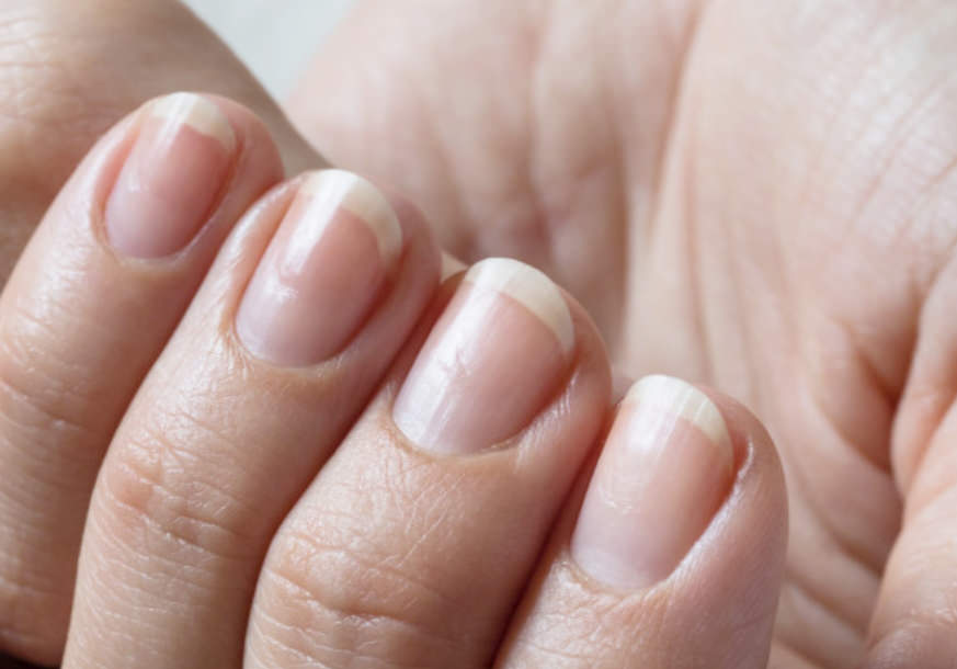 세로줄이 생긴 손톱