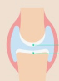 연골연화증 치료