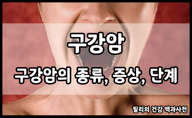 구강암 : 구강암의 종류&#44; 증상&#44; 단계