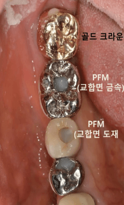 임플란트 보철재 비교 총정리 (Gold PFM Zirconia )