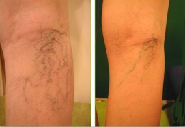 하지정맥류-수술비용