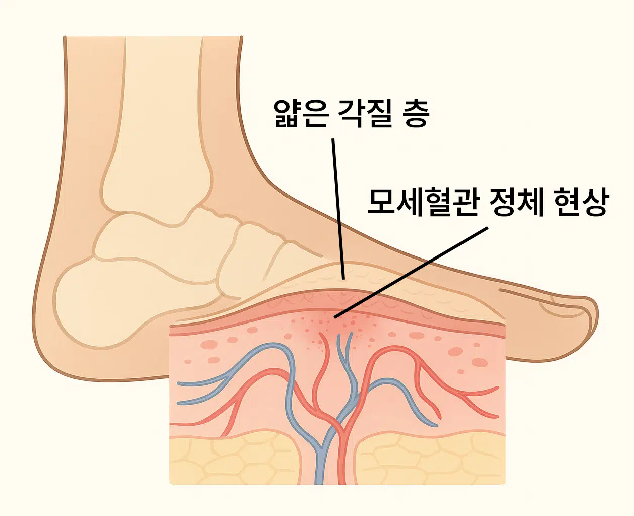 복숭아뼈 단면 해부도 위에 모세혈관 정체와 얇은 각질층
