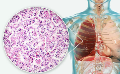 폐렴구균 예방접종 횟수 비용 무료 접종후 주의사항 총정리(최신 2024년)