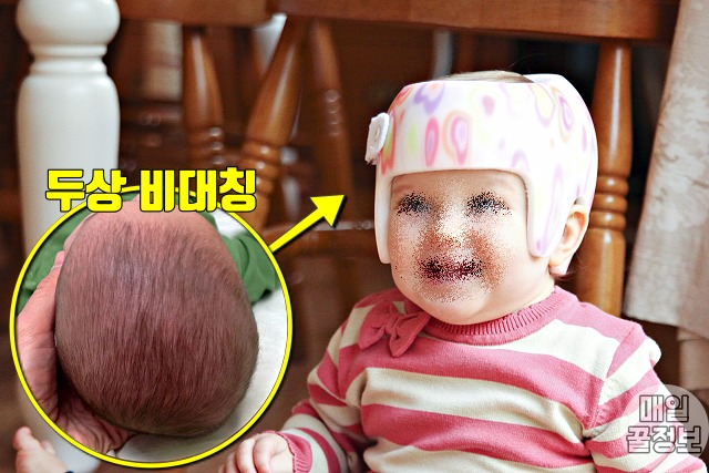 아기 두상 비대칭 사두증 두상교정헬멧추천