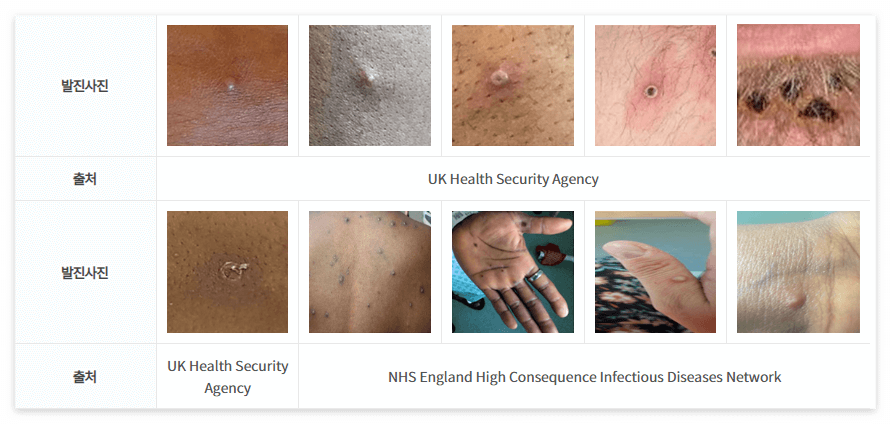 엠폭스원숭이두창