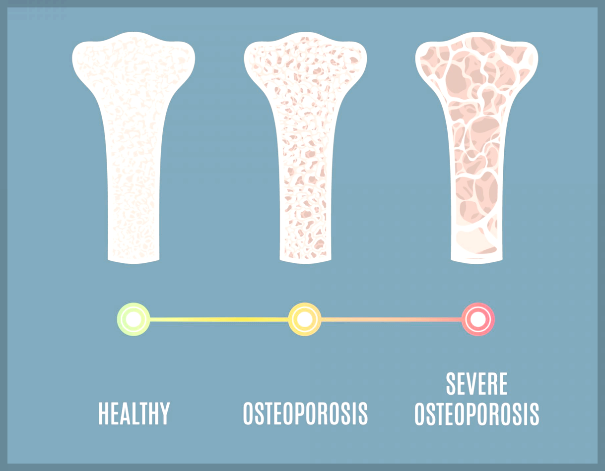 골다공증 검사, 수치분석 및 좋은 음식 영양제 등 5분 정리
