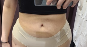 복부지방흡입 후기