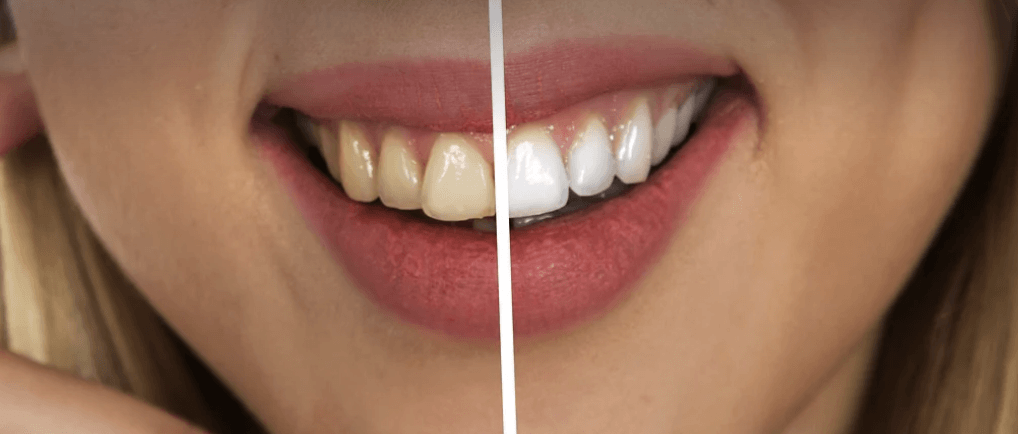 치아 미백 전, 후 사진
