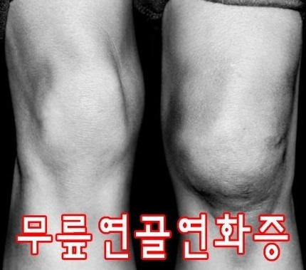 무릎 연골 연화증