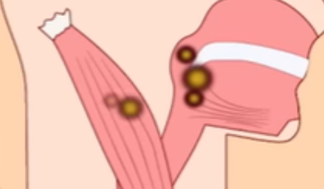 구강암의 증상