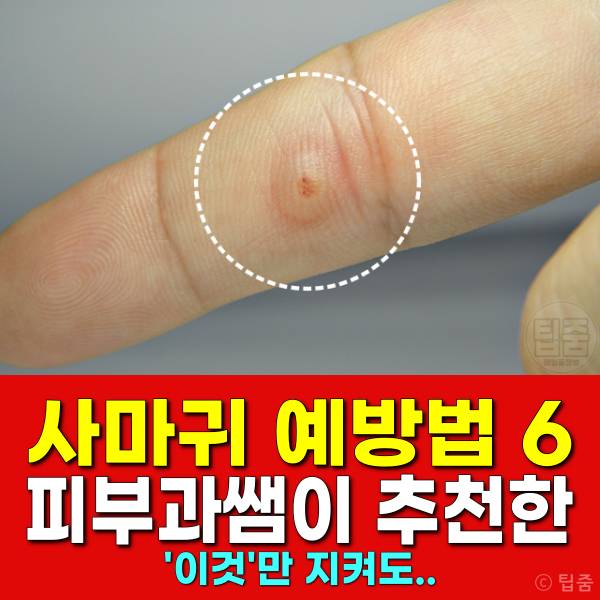 사마귀예방 사마귀 제거 연고