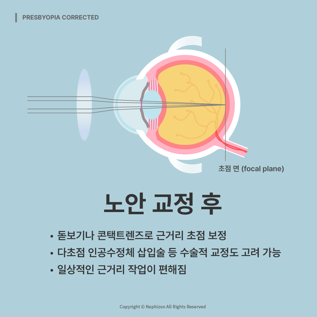 노안 교정 후