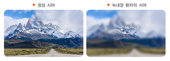 녹내장-원인-설명하는-사진