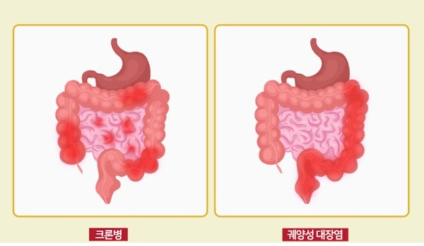 염증성 장질환