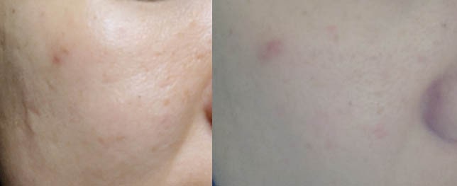 리톤72 바르기 전후 비교 사진