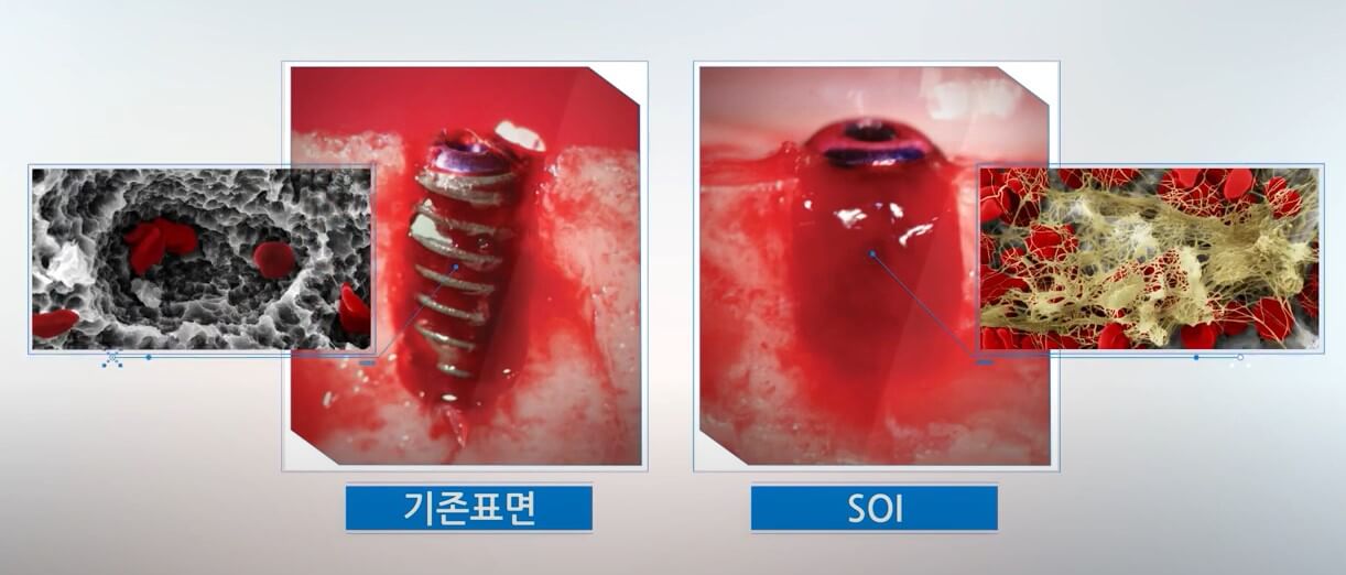 혈병 골융합 과정