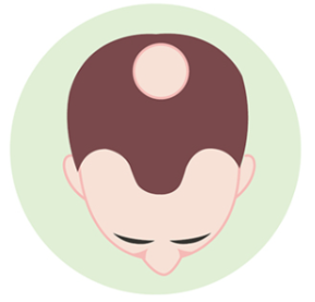 원형탈모는 정수리 부분이 원형으로 빠진다.