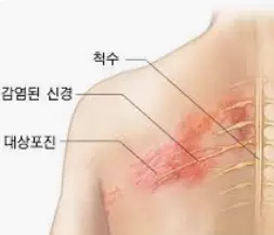대상포진에-좋은-음식-대상포진-치료법-건강