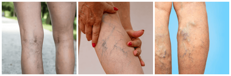 하지정맥류 관련 사진 3개