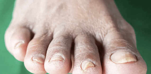 여름철 무좀 원인, 무좀 증상, 무좀 약 치료 방법 총정리