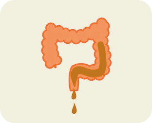 물설사-원인-멈추는 방법