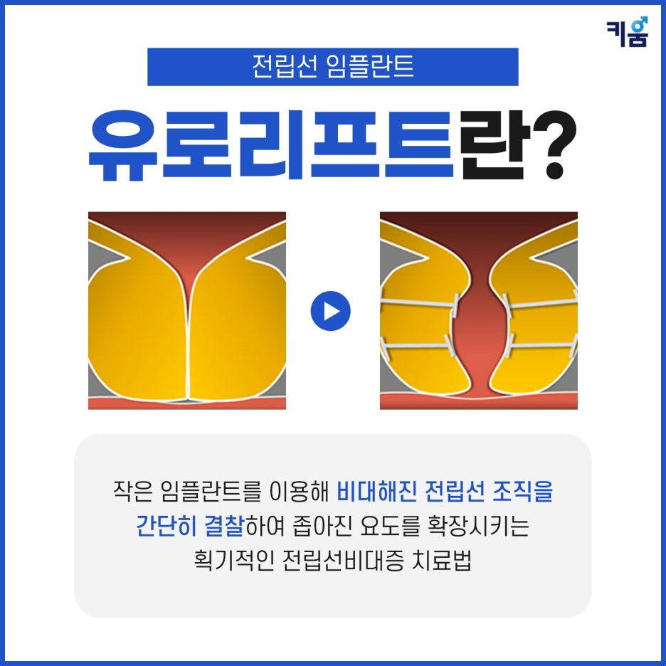 유로리프트란 ? 이미지