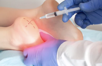 족저 근막염 치료