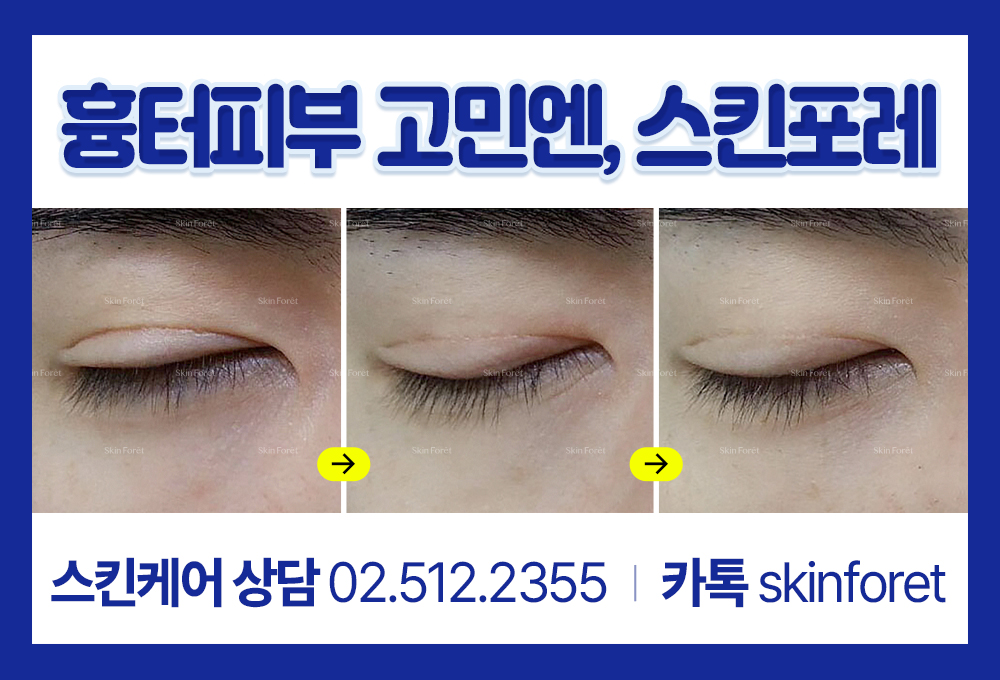 남자 앞트임과 짝눈 교정, 붓기 감소 실제 후기 이미지