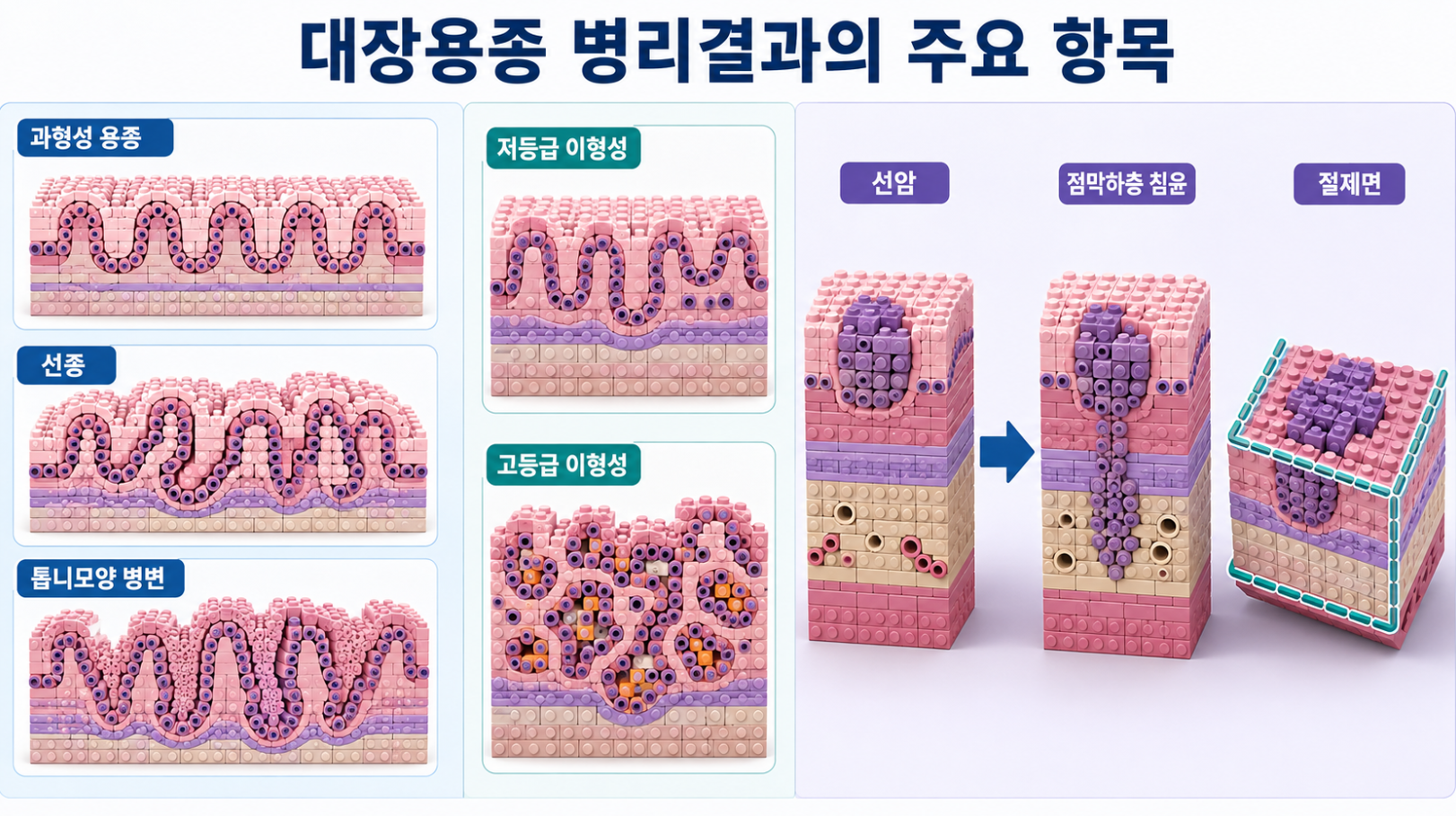 과형성 용종·선종·톱니모양 병변과 저등급·고등급 이형성, 선암·점막하층 침윤·절제면 비교