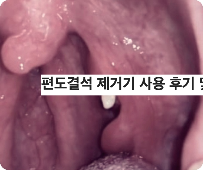 편도결석 제거기 사용 후기 및 방법