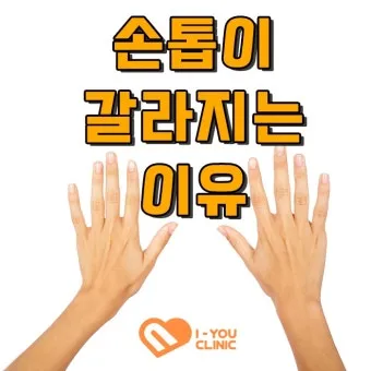 손톱이 갈라지는 이유 원인 증상 대처법_4