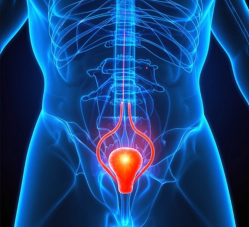 요도암 관련 이미지