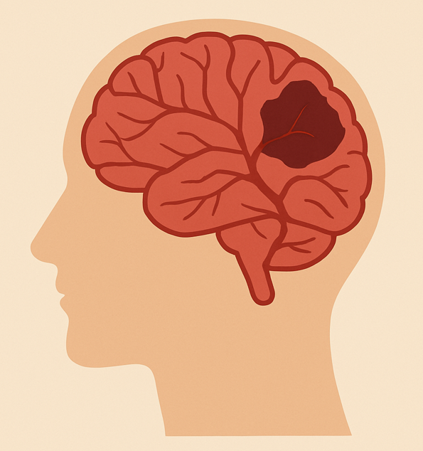 뇌졸중을 표현한 이미지