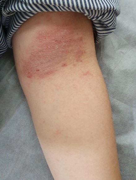 아토피 가려움증 해소방법 11가지