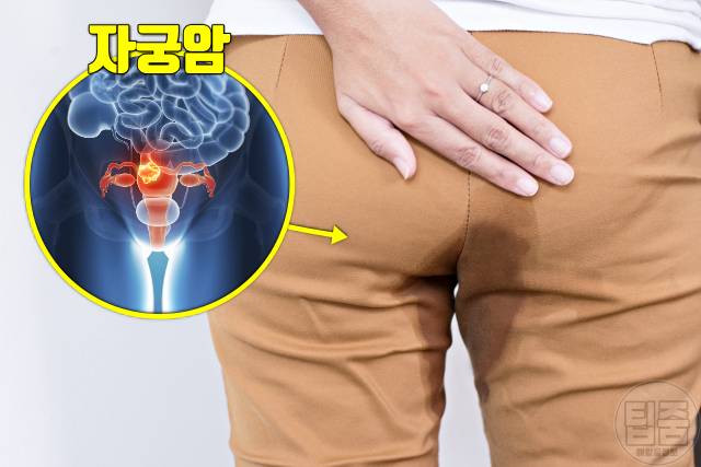 소변이 새요 요실금 원인 자궁암 자궁적출