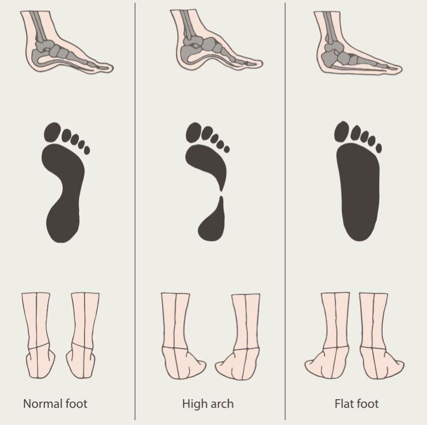 한국인에게 흔한 평발, 교정법 총정리