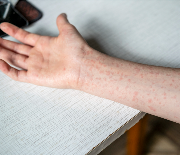 홍역 증상 완벽 가이드