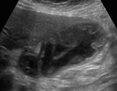 괴저성 담낭염 (Gangrenous cholecystitis)