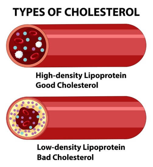혈관 속 혈액 찌꺼기 양을 보여주는 모습